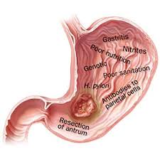 Your doctor may identify signs of stomach cancer, such as enlarged lymph nodes or liver, increased fluid in the abdomen (ascites), or bumps (nodules) in or under the skin of the abdomen during a. Stomach Cancer Oesophageal Gastric Cancer Melbourne Gastro Surgery