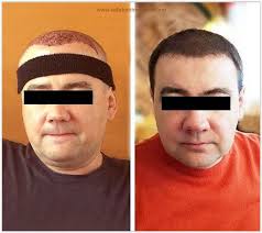 زراعة الشعر تركيا قبل وبعد Hair Transplant Best Hair Transplant World Hair