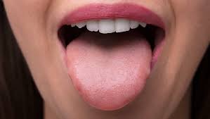 Image result for yellow tongue infection