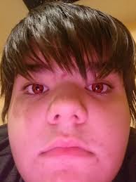 Sharingan Contact Lenses Came In Today My Face Is Acne Ridden But Whatever Naruto Find great deals on ebay for sharingan contacts lenses. sharingan contact lenses came in today