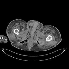 Joint trust clinical procedure for managing fournier's gangrene v1.1; Fournier S Gangrene Radiology Case Radiopaedia Org