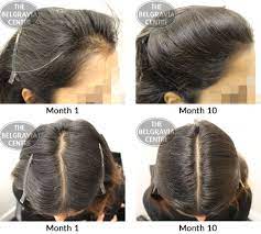 Hair loss in your 30s is more common than we realize if you try counting each one and notice you are losing more hair than normal and they are not growing back, then you have hair loss. Hair Growth Success My Hair Looks Amazing And Is Full Of Volume Again