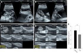 True clubfoot is characterized by abnormal bone. Taz And Myostatin Involved In Muscle Atrophy Of Congenital Neurogenic Clubfoot