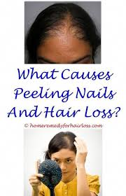 Hibiscus Tea Hair Loss Does Humidity Cause Hair Loss Man S 17 Years Of Hair Loss In One Time Lapse Video He Help Hair Loss Hair Loss Women Hair Loss Remedies
