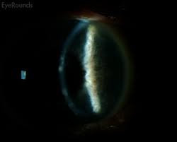 Jeng says stromal keratitis comes in two varieties: Herpes Simplex Keratitis