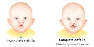 Image result for Cleft Lip