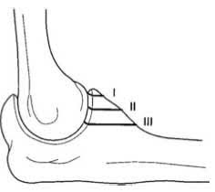 Image result for Coronoid Process Fracture