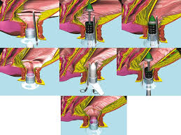 Chronic constipation and its comorbid conditions. End Und Dickdarm Zentrum Essen Verstopfung Stuhlentleerungsstorung