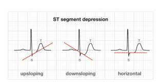 Ecg library waves, intervals, segments and clinical interpretation Links To And Excerpts From Life In The Fast Lane S Ecg Exam Template Tom Wade Md