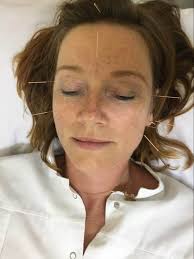 Akupunktur og Kranio-Sakral Terapi i Holbæk