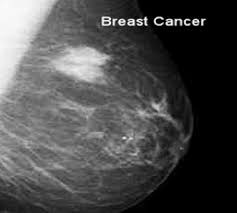 We'll show you breast cancer pictures to help you identify any physical traits of the condition. Mammography Report The Abnormal Mammogram Moose And Doc