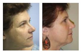 Brow Lift in Jacksonville, Florida by David N. Csikai, M.D.