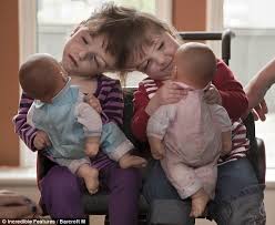 Unbelievable medical conditions (2010), medical incredible (2005) and face to face: Do These Amazing Conjoined Twin Girls Share One Mind Daily Mail Online