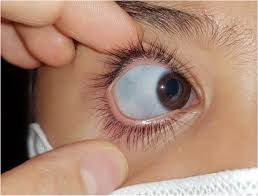 Image result for Sclera