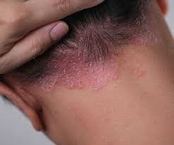 Image result for dermatitis contacta