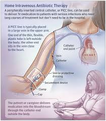 Dwelling Intravenous Antibiotic Remedy Intravenous Medical Medical Knowledge