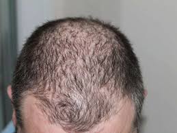 If you notice unusual hair loss of any kind, it's important to see your primary care provider or a dermatologist, to determine the cause and appropriate treatment. Significant Hair Loss And Thinning Advanced Derm Of The Midlands