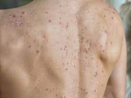 Spot treat blemishes the same spot treatments you apply to your face can be used for your back, chest and shoulders. Back Acne How To Get Rid Of It And How To Prevent It