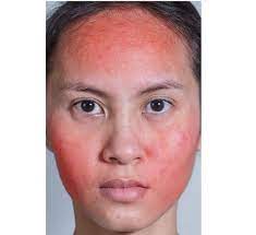 Systemic lupus erythematosus (sle) is a chronic inflammatory disease that has protean manifestations and follows a relapsing and remitting course. Patients With Cutaneous Lupus Erythematosus Susceptible To Other Autoimmune Conditions