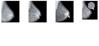 The Differences Between Benign And Malignant Tumors In Breast Cancer Download Scientific Diagram
