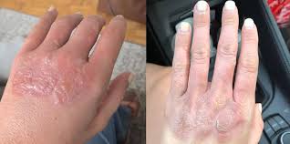 Image result for Photodermatitis