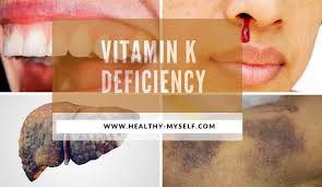 Are You Missing This Vitamin K Deficiency Update For 2020 In 2020 Vitamin K Deficiency Vitamin K Vitamins