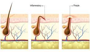 It can cause inflammation, pain and tiny bumps in the area where the hair was removed. Ingrown Beard Hairs Prevention Proven Remedies Guide