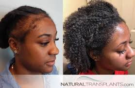 Traction Alopecia Tuesday Female Hair Transplant Before And After Images Weekly Contact Us Today At Hair Restoration Traction Alopecia Hair Transplant Women