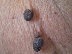 Thrombosed hemorrhoid skin tag removal. What Are Skin Tags Causes And Treatment Options
