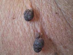 Learn about the academy's efforts to refocus its brand on education. Cancerous Skin Tags Pictures Removal And More