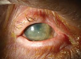 Image result for lesion sclera