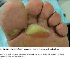 Or, the cause of a symptom may be a different medical condition that is not cancer. Prevention And Management Of Hand Foot Syndromes Oncology Nurse Advisor