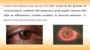 Image result for Acute Red Eye