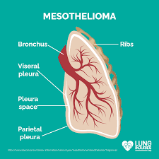 How can mesothelioma be prevented? Mesothelioma Lung Injuries