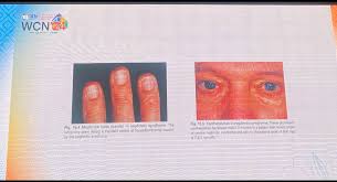 Image result for Muehrcke Line