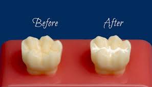 With this method, each grout line is brushed individually with a small brush and sealant. Dental Sealants Dentist In Killeen Tx