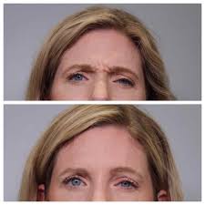 Aging doesn't have to show up on your face. Best Botox Before And After In Houston Artavi Med Spa Artavi Med Spa