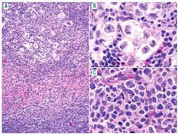 Mutational landscape of grey zone lymphoma. Methylation Profiling Of Mediastinal Gray Zone Lymphoma Reveals A Distinctive Signature With Elements Shared By Classical Hodgkin S Lymphoma And Primary Mediastinal Large B Cell Lymphoma Haematologica