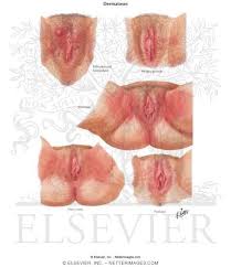 Image result for Vulvitis