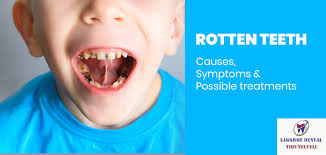 The man has rotten teeth, teeth fell out, yellow and black teeth hurt. Rotten Teeth Causes Symptoms Possible Treatments