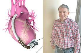 A vadis used in people who have weakened hearts or heart failure. Dothan Man Sees Improvement In Quality Of Life After Lvad Surgery News Uab