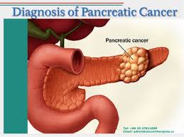 Reviewing your test results enables your care team to put together a keep in mind that these symptoms aren't always due to pancreatic cancer and may be the result preventive screenings for pancreatic cancer are available but usually geared toward patients who. Diagnosis Of Pancreatic Cancer