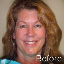 Grand Rapids Dentist Dr. Randall Chambers Satisfied Patients Before and  After