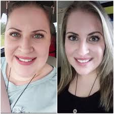 I had the gastric bypass