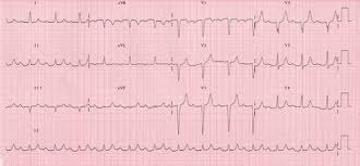 Ecg Chart Paper