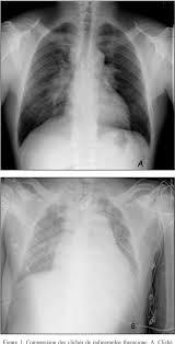 Acute pericarditis is an inflammation of the pericardium characterized by chest pain, pericardial friction rub, and serial ecg changes. Figure 3 From Le Cas Clinique Du Mois Pericardite Purulente Chez Un Patient Atteint De Sarcoidose Pulmonaire Semantic Scholar