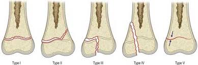 Image result for Growth Plate