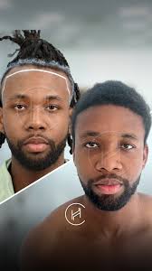 🌟 Our client Darrius Flowers visited our clinic for a hair transplant and  is extremely satisfied with the results! @beastmodeufc As a UFC fighter,  Darrius shares his experience and recommends our clinic