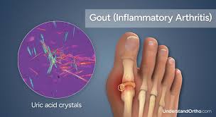 Image result for gout