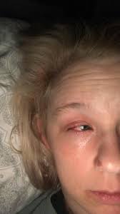 Hello! I suddenly developed severe pain in my left eye this morning. I  rubbed it for a few mins (likely a bad idea) and throughout the day it has  worsened. I saw